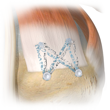 ZB-3 from Zimmer Biomet