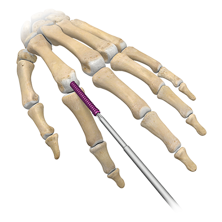 A.L.P.S. mvX™ IM Nail Z-KIT™