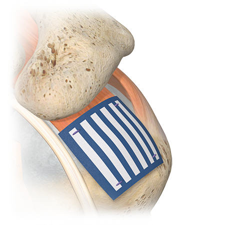 ZB-3 from Zimmer Biomet