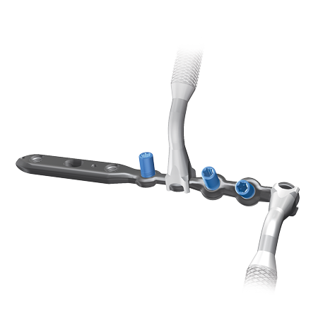 その他 FaB Adaptive Plating RF A.L.P.S.® Fibula Plating Systems