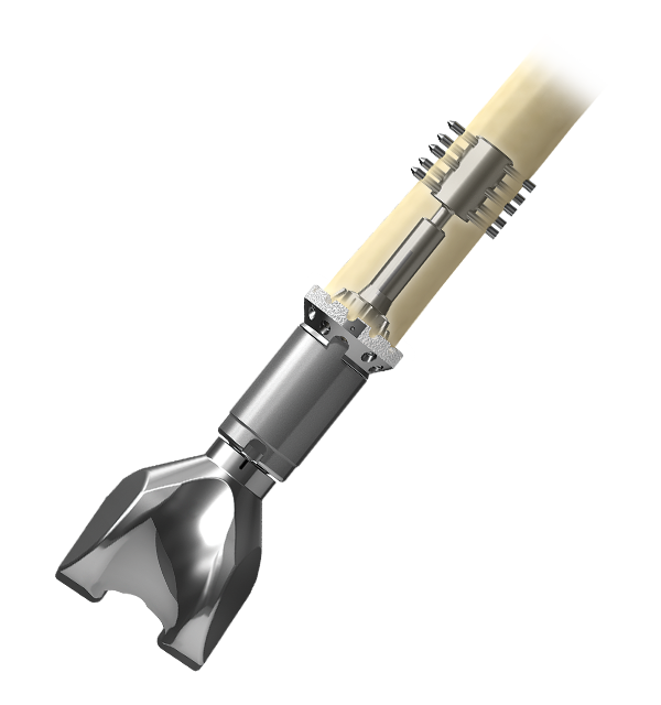 OSS™ Orthopedic Salvage System Compress® Device at Zimmer Biomet