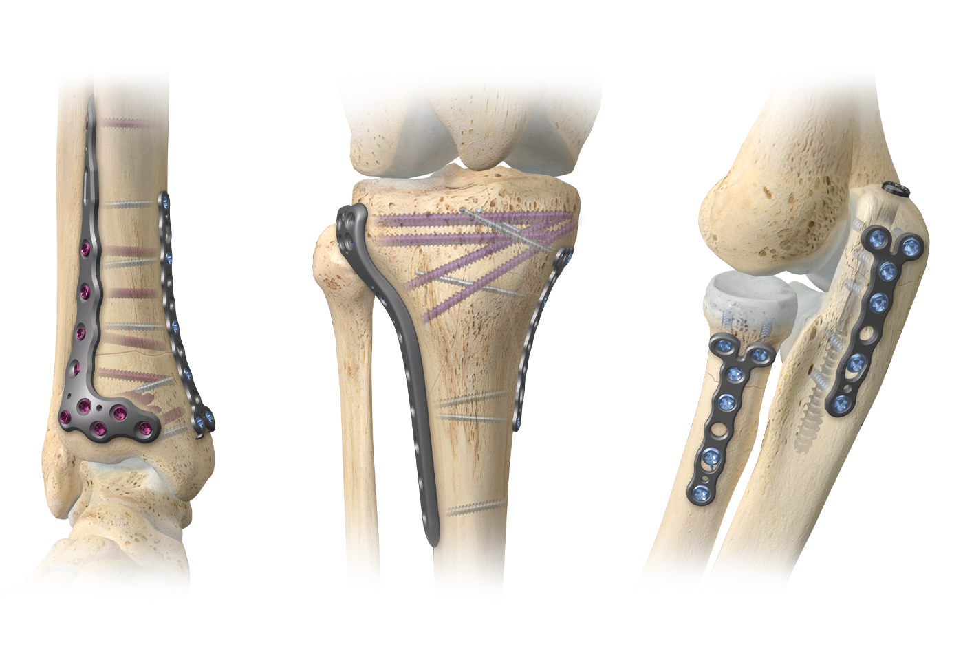 A.L.P.S. mvX™ Mini Fragment System | Zimmer Biomet