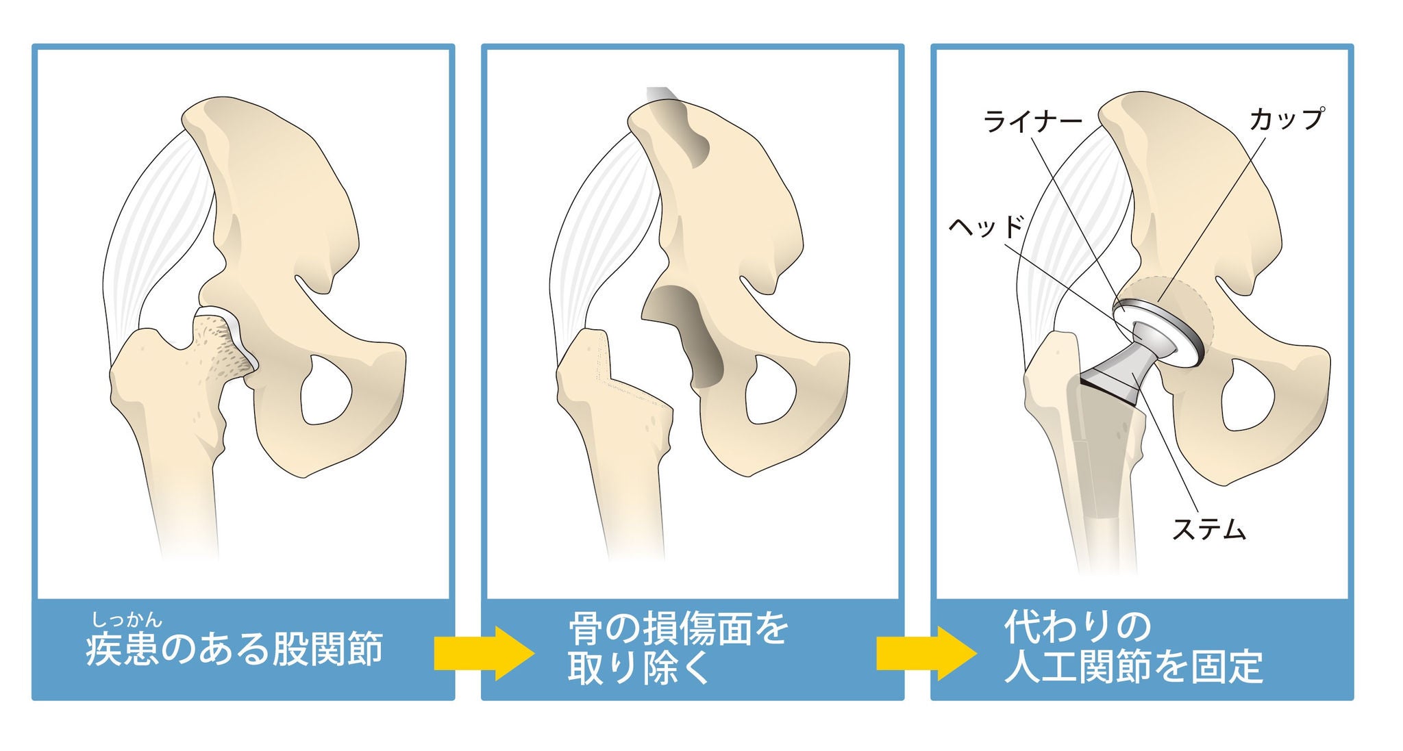 人工股関節12-1