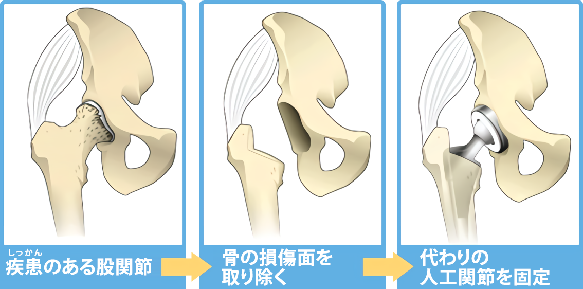 Резекция тазобедренного сустава. Резекция тазобедренного сустава. Резекция тазобедренного сустава. Артротомия тазобедренного сустава. Тотальное гибридное эндопротезирование тазобедренного сустава.