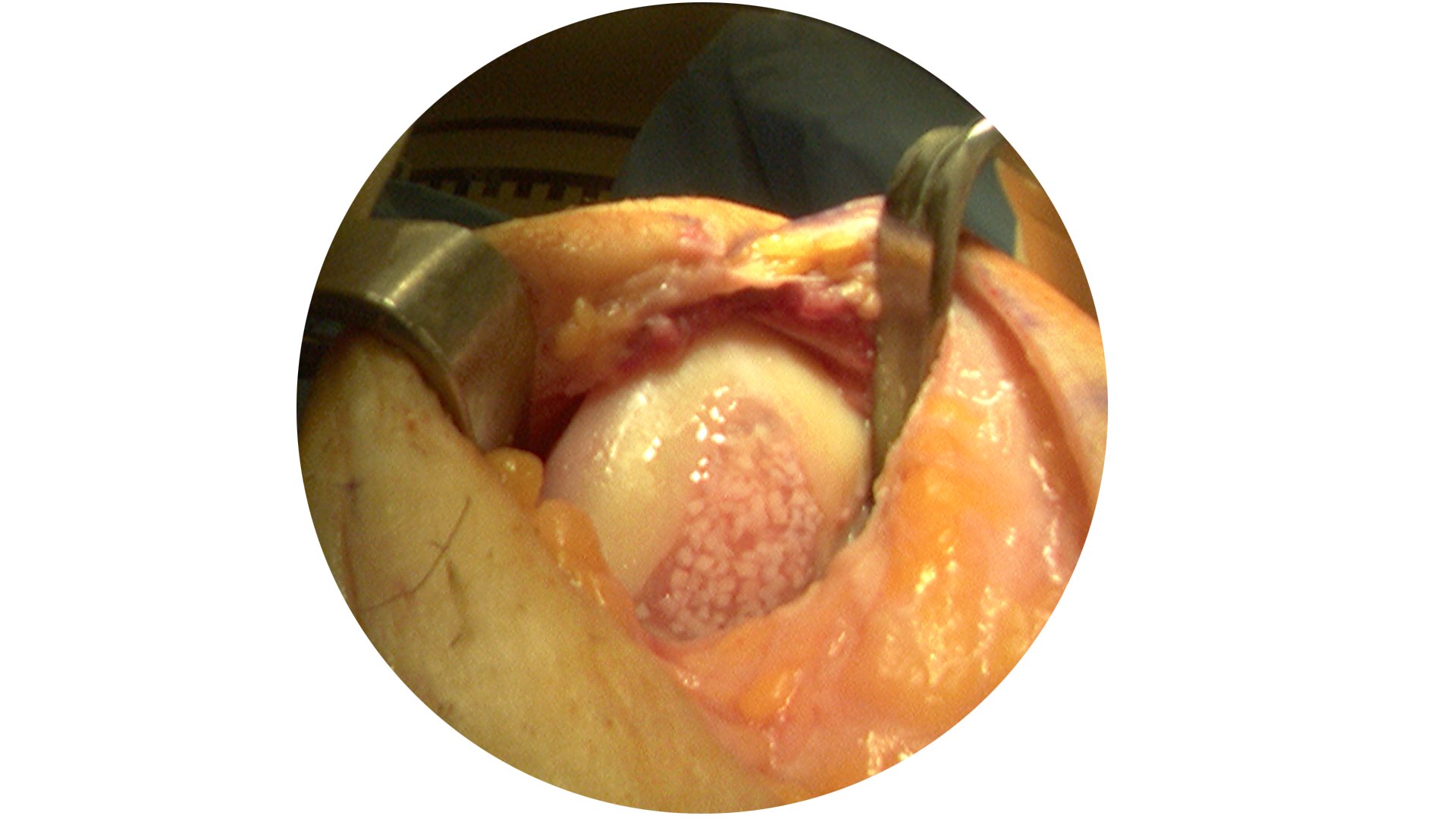 Articular Cartilage Restoration Knee Ligament Repair Articular