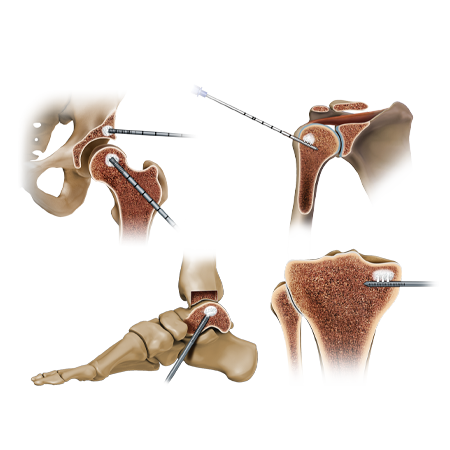 The Subchondroplasty®(SCP®) Procedure