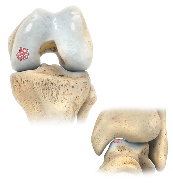 Osteochondral Allograft (OCA) Kit