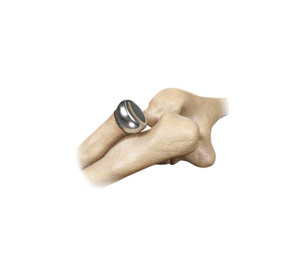L2L® Radial Heads from Zimmer Biomet L2L® Radial Heads from Zimmer Biomet