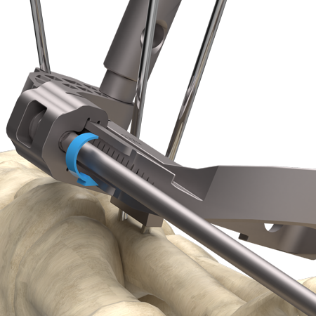 InCore® TMT System | Zimmer Biomet