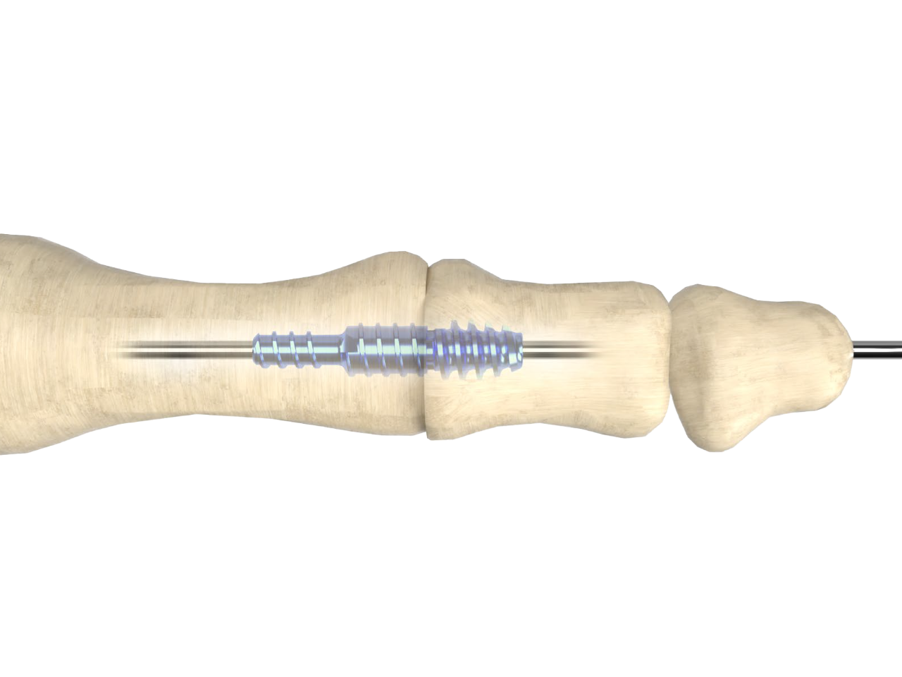 Nextra® CH Cannulated Hammertoe Correction | Zimmer Biomet
