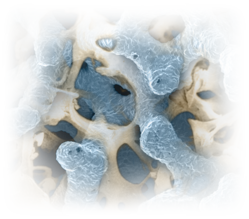 Zimmer Biomet’s Trabecular Metal® Technology Zimmer Biomet’s Trabecular Metal® Technology