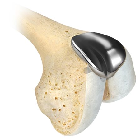 Zimmer Biomet's Gender Solutions®  Patello-Femoral Joint System