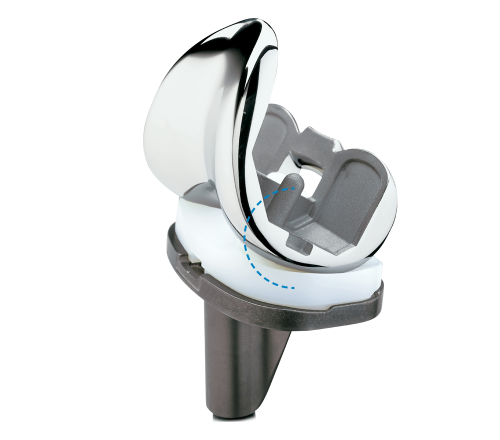 NexGen Legacy® LPS-Flex Knee