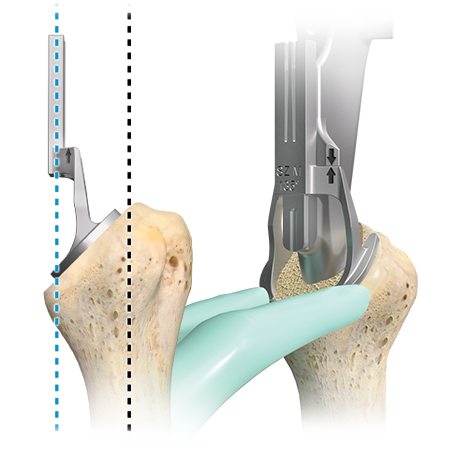 Identity Shoulder System from Zimmer Biomet