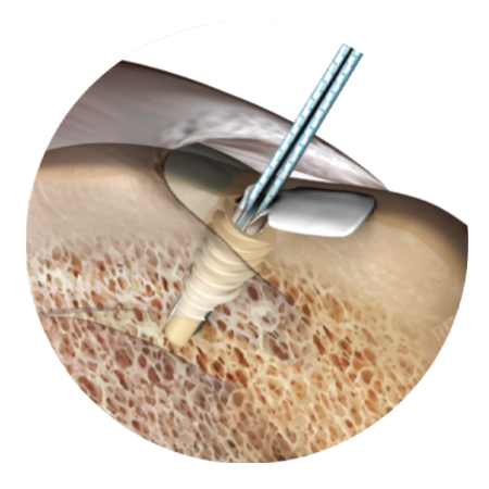 BioWick® Interpositional  Scaffold Implant from Zimmer Biomet