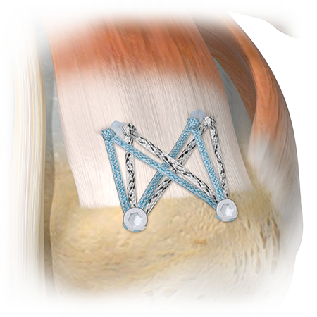Zimmer Biomet's ActivBridge™ Construct Soft Tissue Repair Augmentation