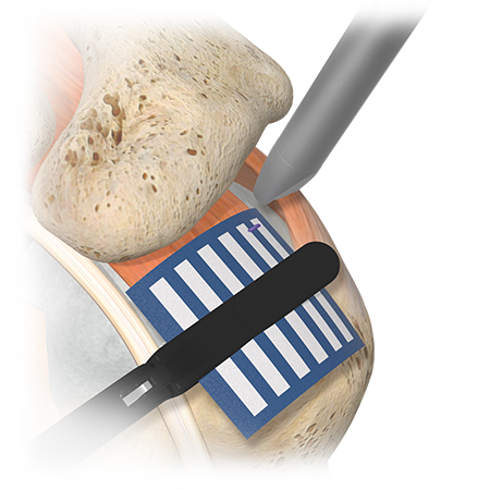 Zimmer Biomet Tapestry® RC Biointegrative Implant System