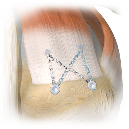 ActivBridge™ Construct Soft Tissue Repair Augmentation