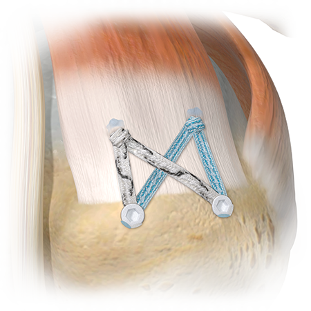 ActivBridge™ Construct Soft Tissue Repair Augmentation