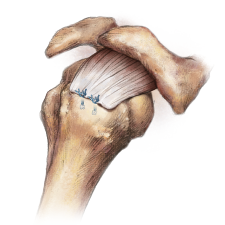 Zimmer Biomet JuggerKnot® Rotator Cuff All-Suture Anchors