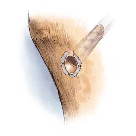 TunneLoc® Tibial Fixation Device from Zimmer Biomet