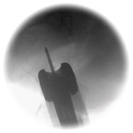 AFFIXUS Hip Fracture Nail System Short Nail  VuMedi