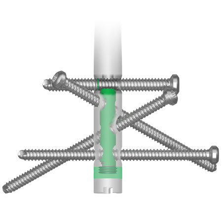 AFFIXUS® Retrograde Femoral Nailing System from Zimmer Biomet