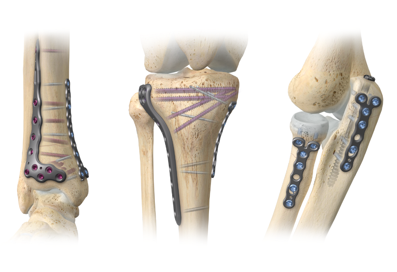 A.L.P.S. mvX™ Mini Fragment System | Zimmer Biomet