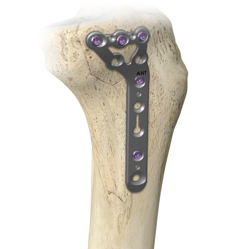 A.L.P.S. mvX® Proximal Tibia System from Zimmer Biomet