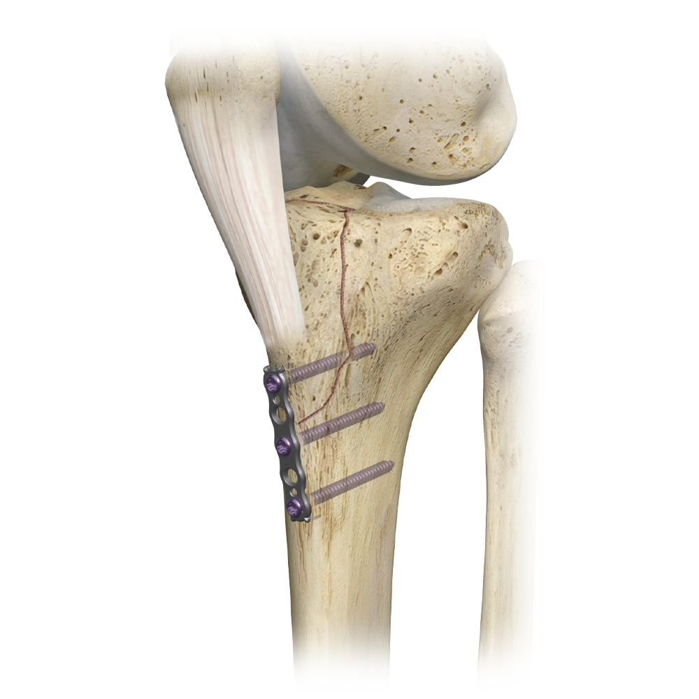 A.L.P.S. mvX® Proximal Tibia System from Zimmer Biomet