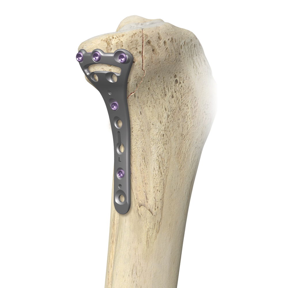 A.L.P.S. mvX® Proximal Tibia System from Zimmer Biomet