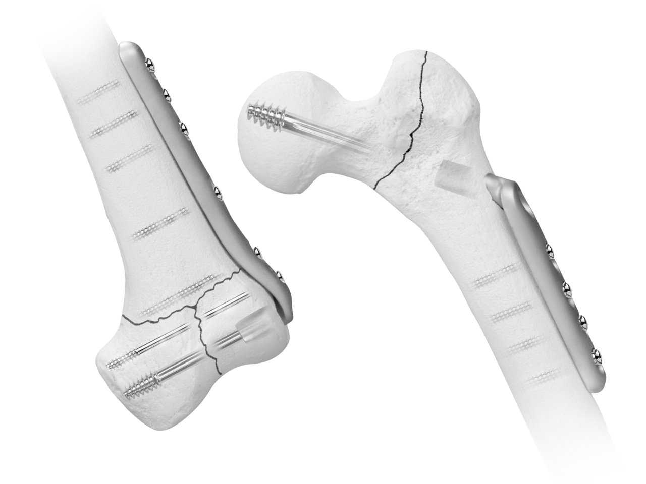 PS2 the 外科医. The cirugiao Versa-Fx® II Femoral Fixation | Zimmer Biomet